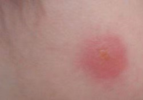 腿被虫子咬了红肿痒?€么办