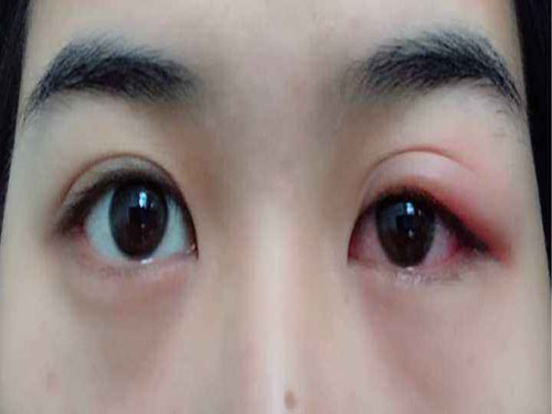眼睑浮肿是什么原因