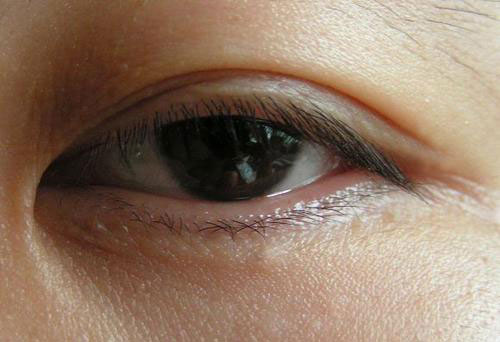 眼球水肿是什么原因引起的 