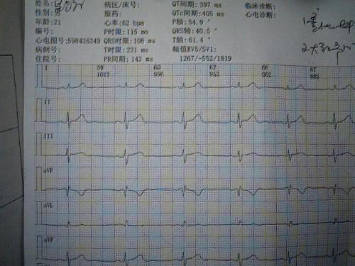 窦性心律过缓伴不齐有什么影响吗窦性心律过缓指如果心电图是窦性