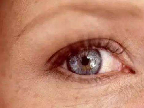 眼角斑点是什么原因