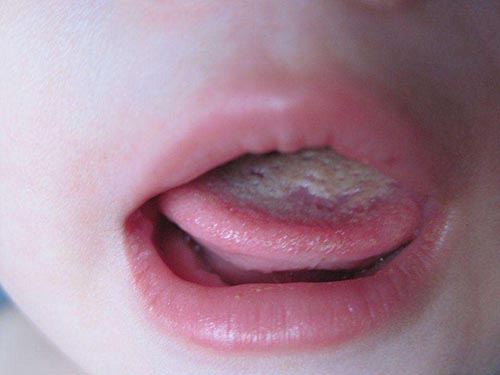  孩子烫到舌头怎么办
