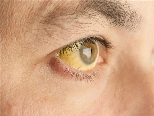 白眼球发黄有血丝是什么原因   白眼球发黄有血丝的注意事项