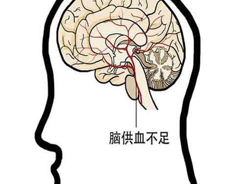 大脑供血不足的症状