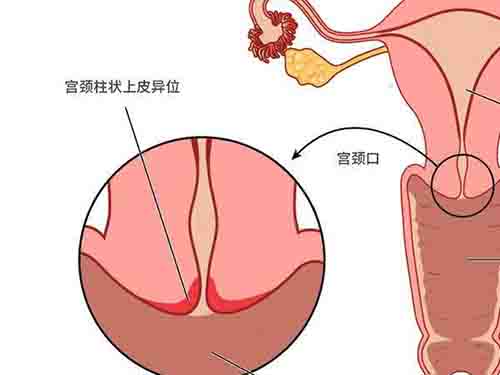 引起宫颈糜烂的原因