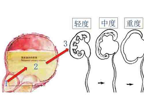 肾积水严重吗