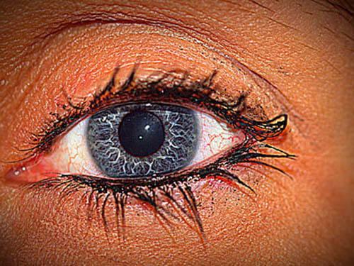 眼周长斑是什么原因