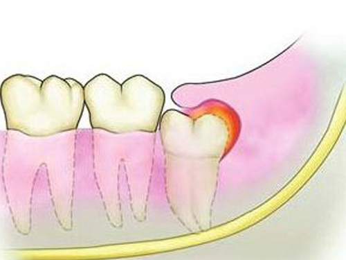 冠周炎如何自我消炎