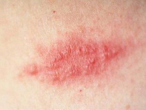 带状疱疹会复发吗带状疱疹通常不复发