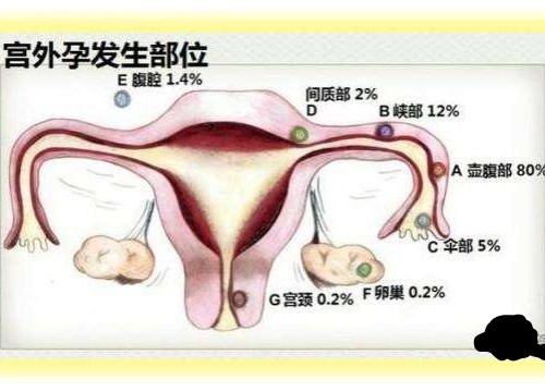 但只有输卵管间质部位妊娠可能会造成较长的停经史,虽然宫外孕也算是