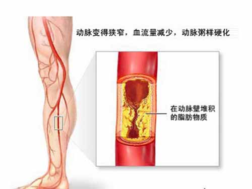  動(dòng)脈硬化的早期癥???