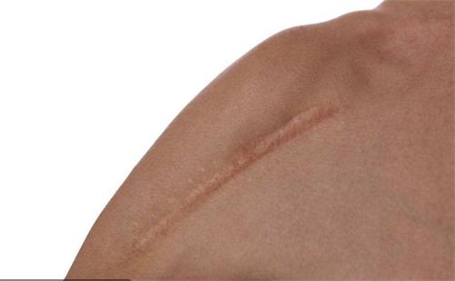 如何自测疤痕体质 疤痕体质怎么自测出来
