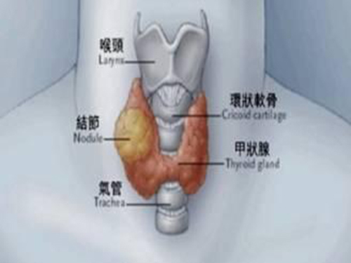 甲状腺结节切除后影响