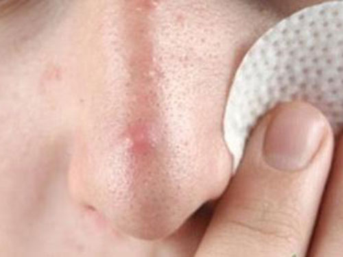 鼻孔口长痘是什么原因