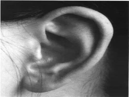中耳炎症状怎么办 中耳炎怎么治疗
