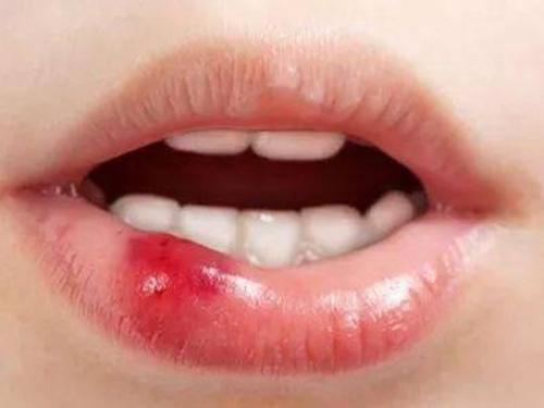 口腔有血泡是什么原因