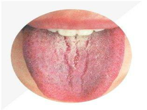 舌后苔白厚是什么原因