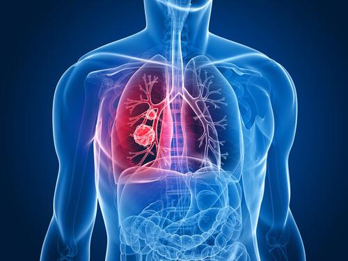 肺部感染的症状是什么
