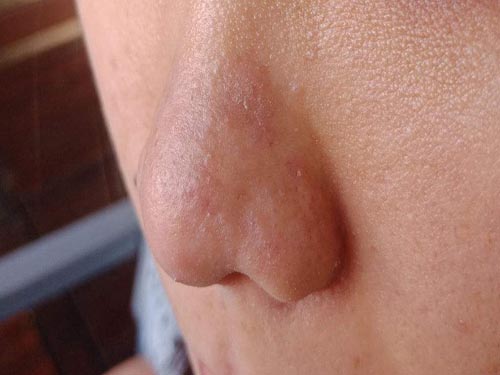 鼻子脱皮是什么原因引起的